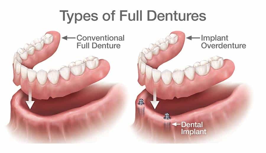 The Basic Principles Of Supported Dentures 
