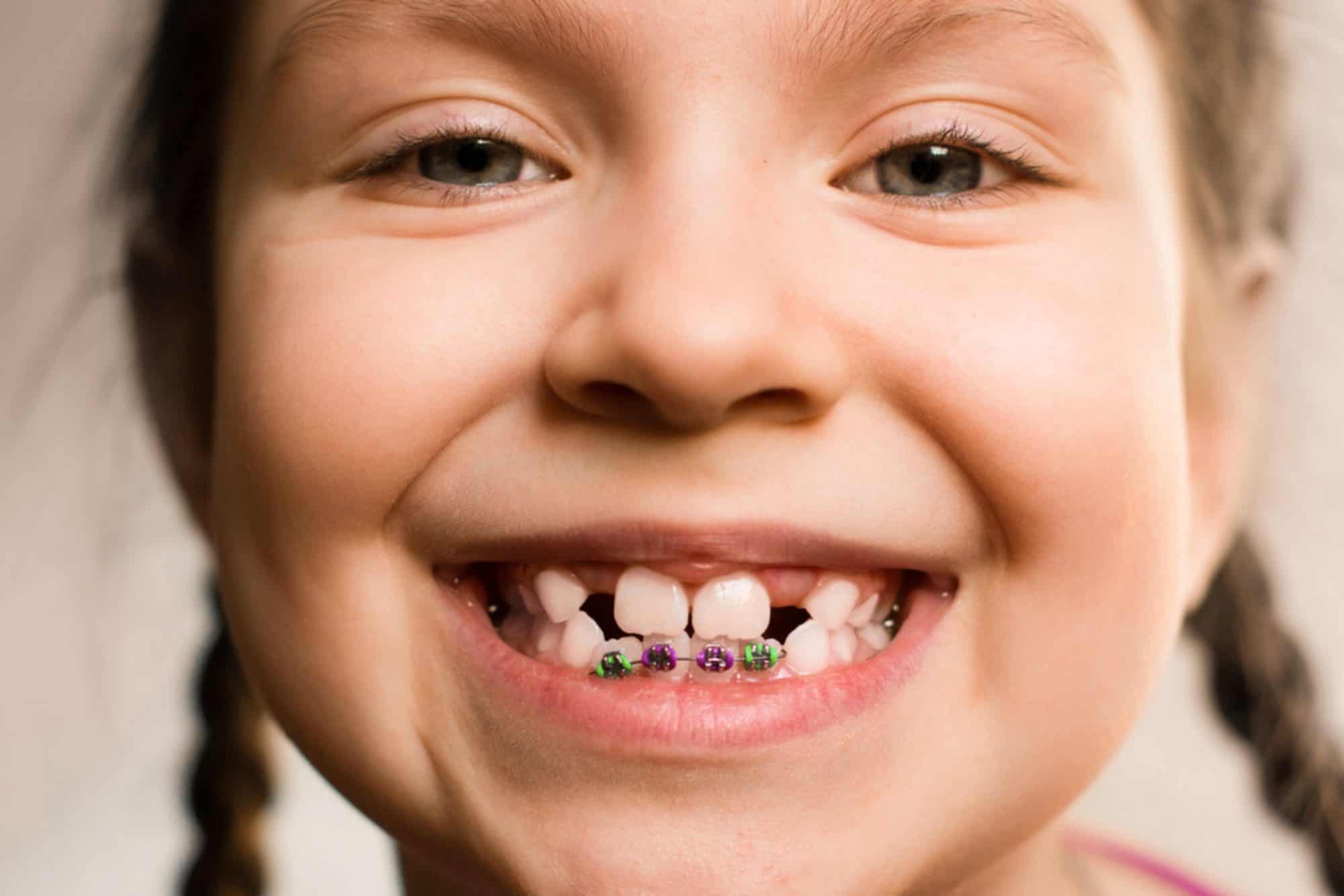 Orthodontics and the Premature or Delayed Loss of Baby Teeth Prairie