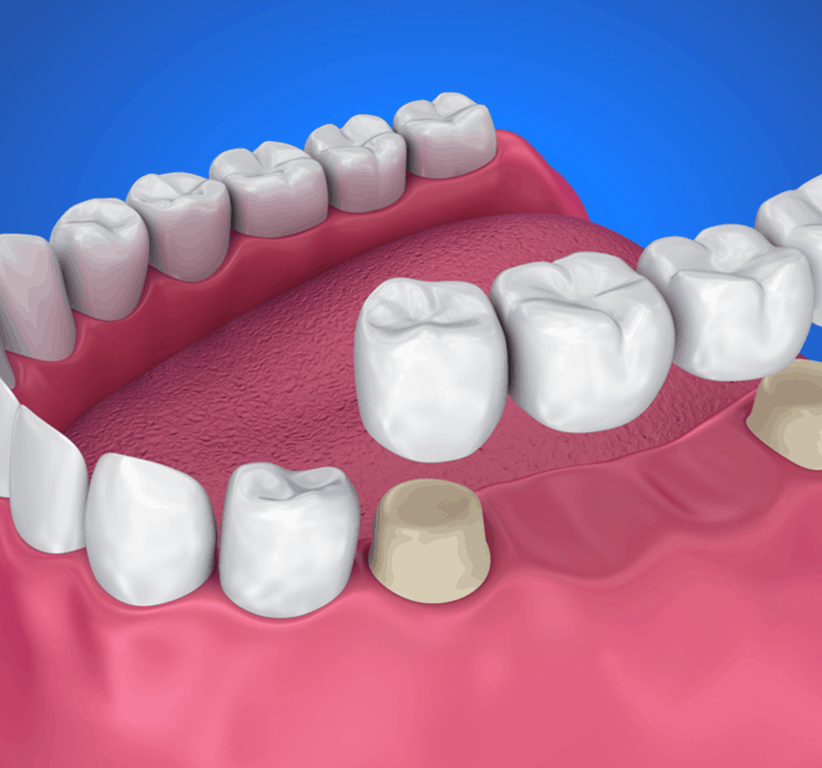 dental bridge in Prince Albert