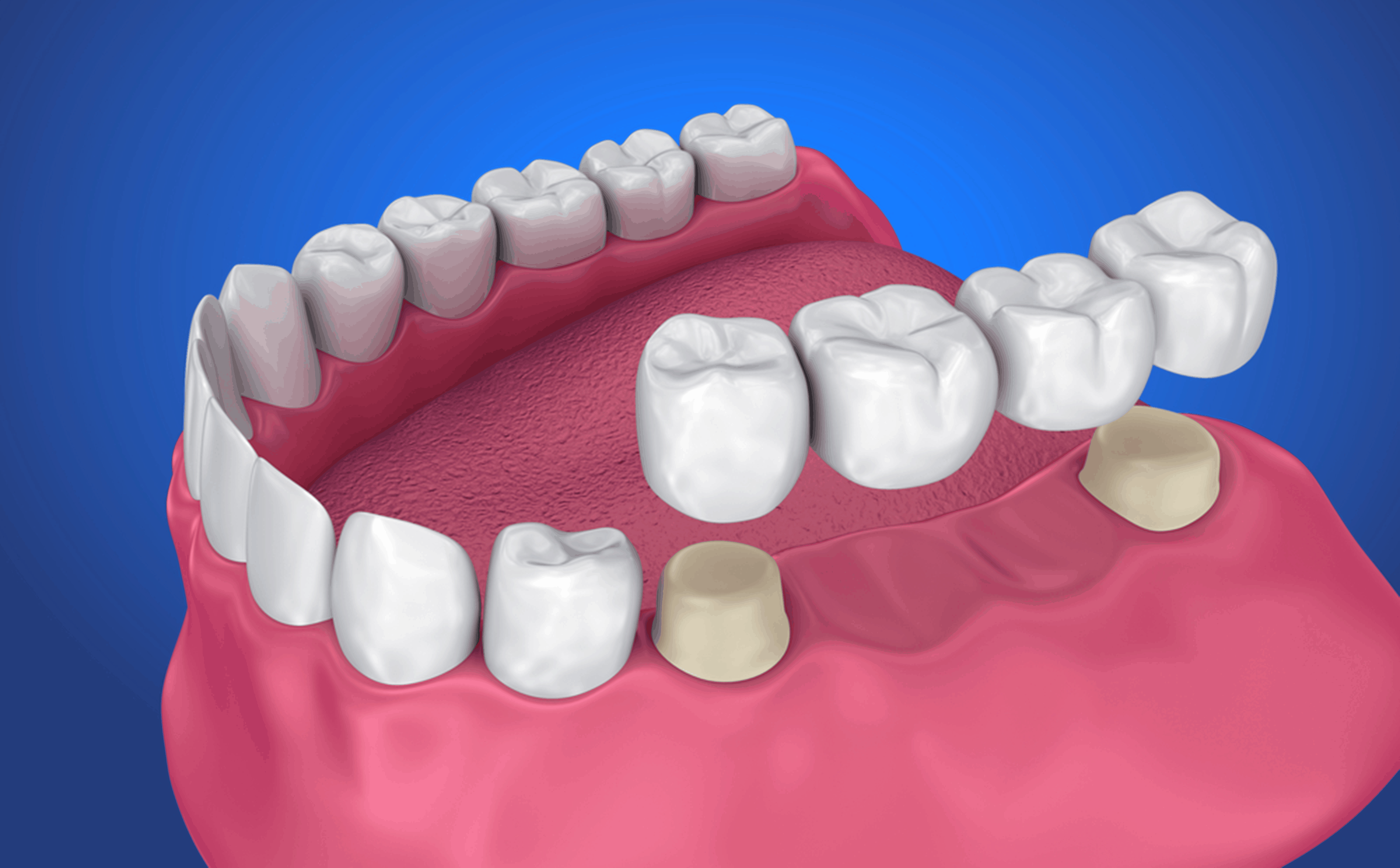 dental bridge in Prince Albert