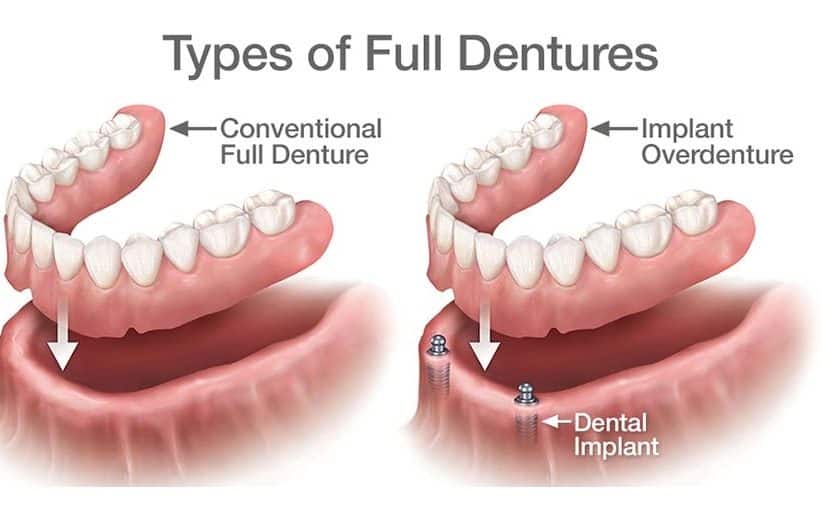 dentures near you