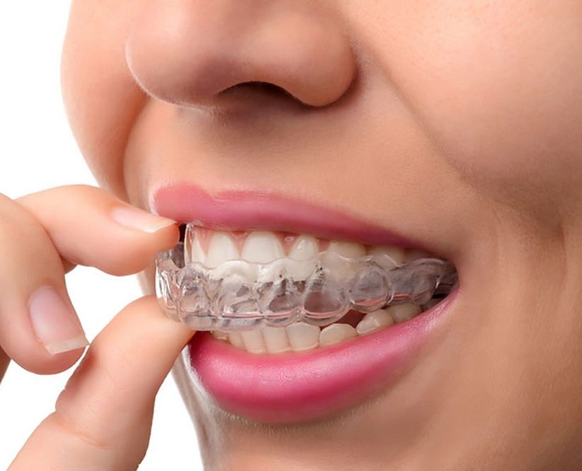 Invisalign in Prince Albert