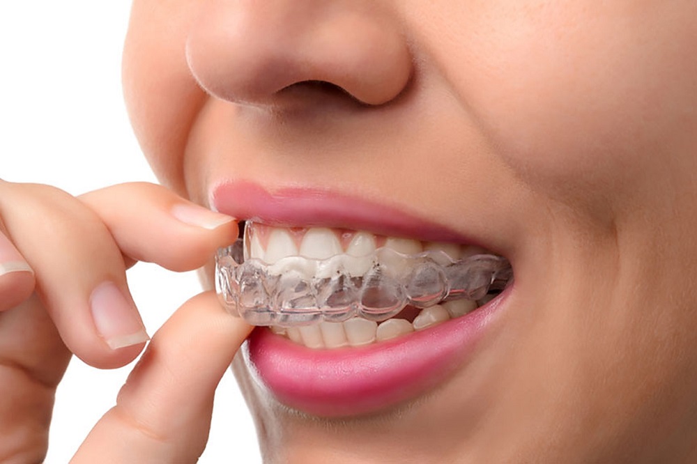 Invisalign in Prince Albert