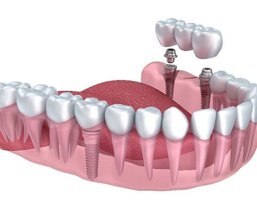 dental implants in Prince Albert