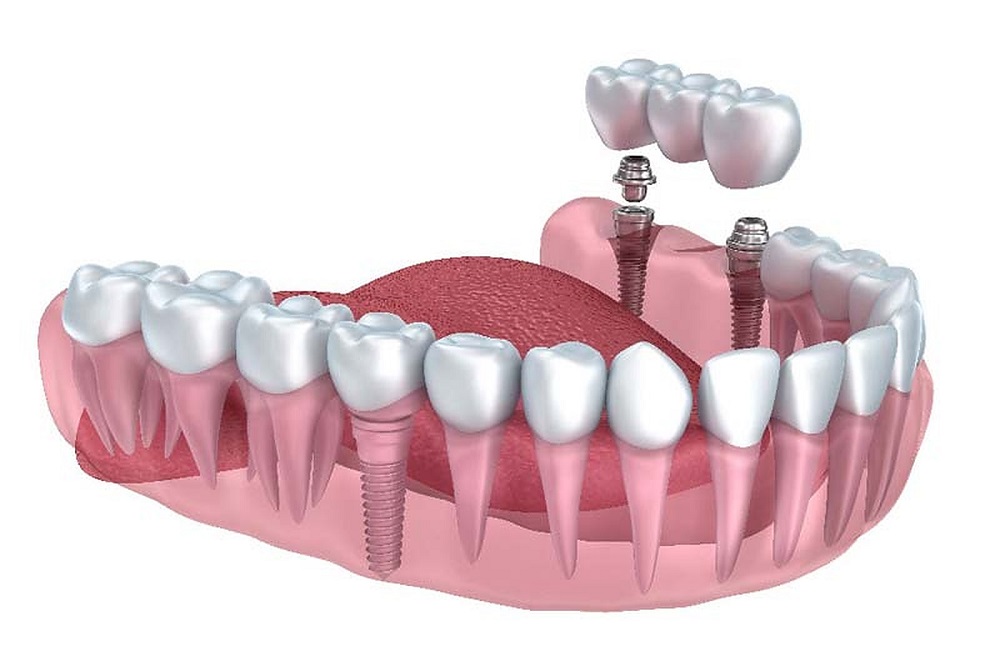 dental implants in Prince Albert