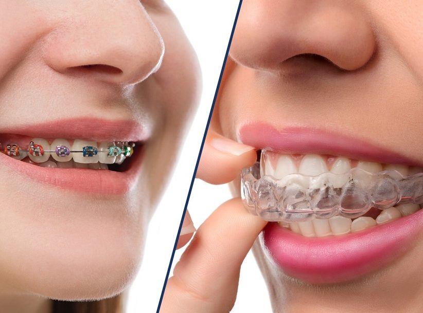 cost of invisalign in canada