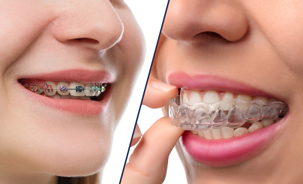 What You Need To Know About Invisalign Treatment - Prairie Pines Dental  Centre