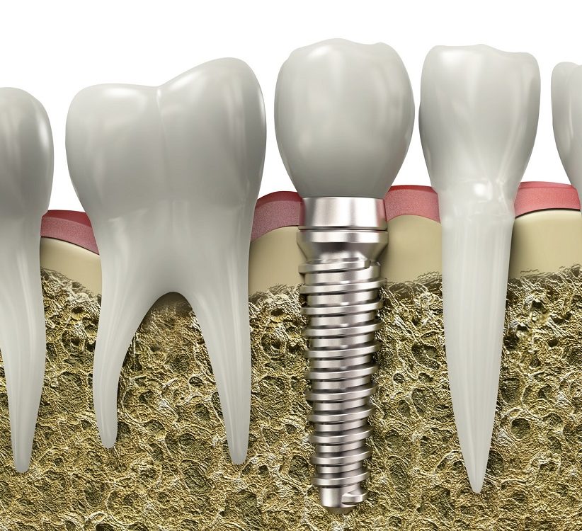 dental implants near you