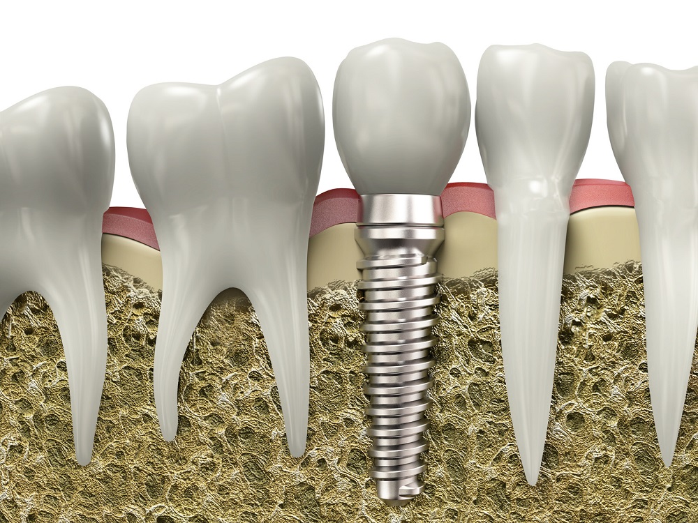 Advantages of Dental Implant Surgery - Prairie Pines Dental Centre