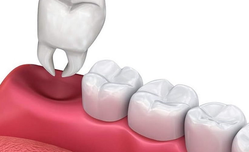 Tooth Extractions in Prince Albert