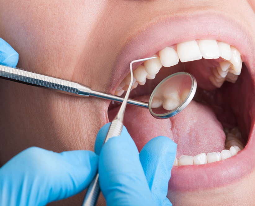 root canal therapy in Prince Albert