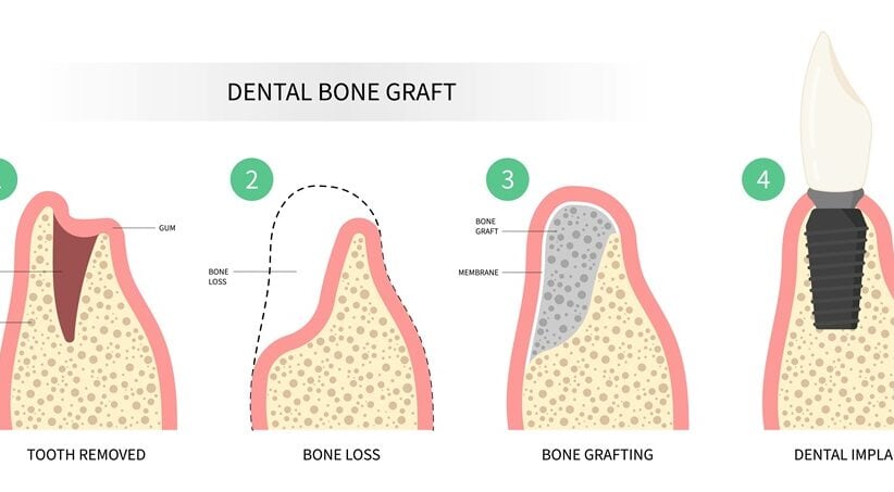 dentures near me