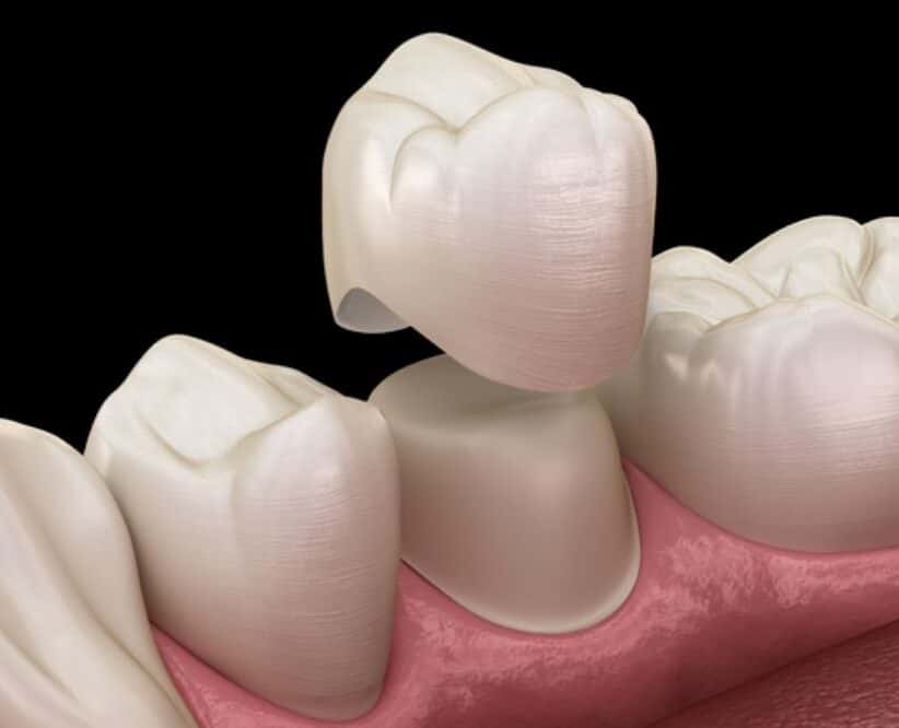 How dental crowns and bridges can restore your smile and confidence