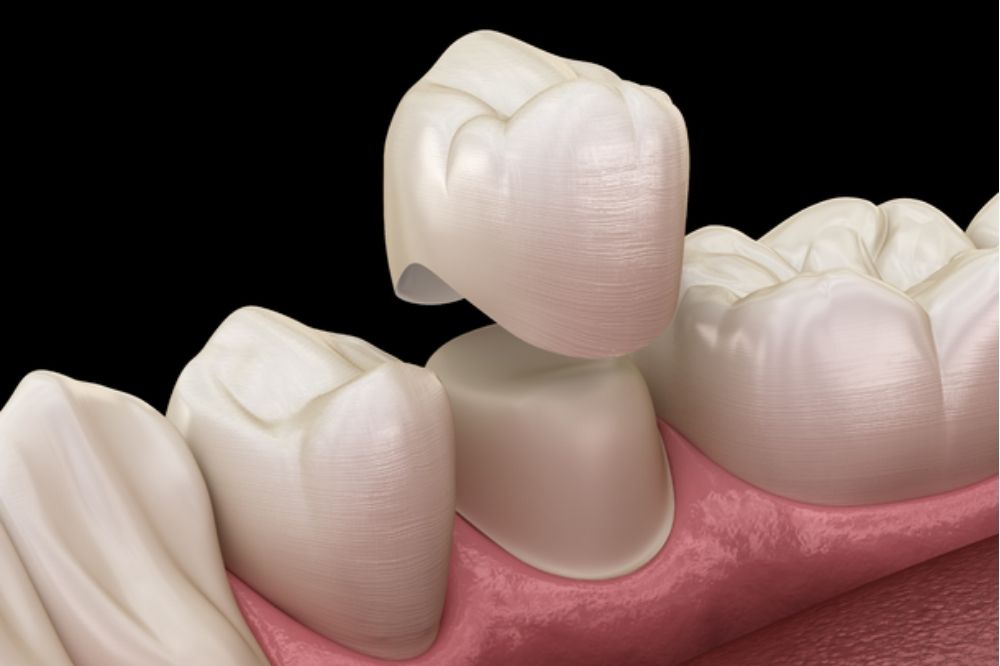How dental crowns and bridges can restore your smile and confidence