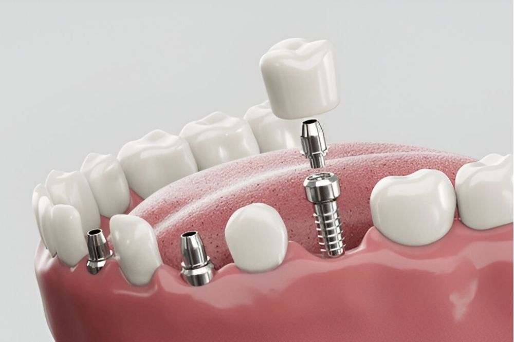 Dental Implants in Prince Albert