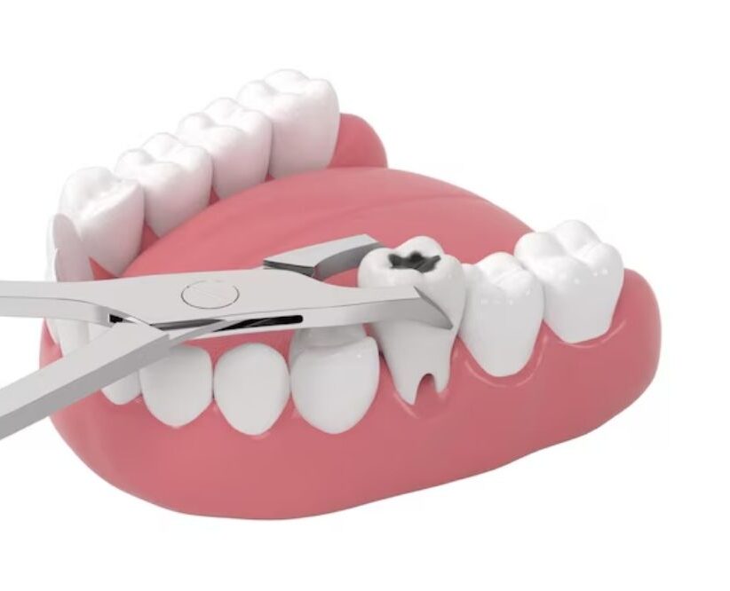 tooth extractions in Prince Albert
