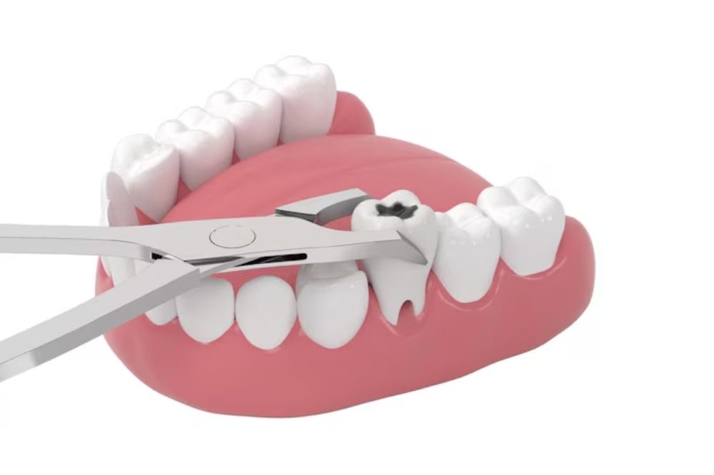 tooth extractions in Prince Albert