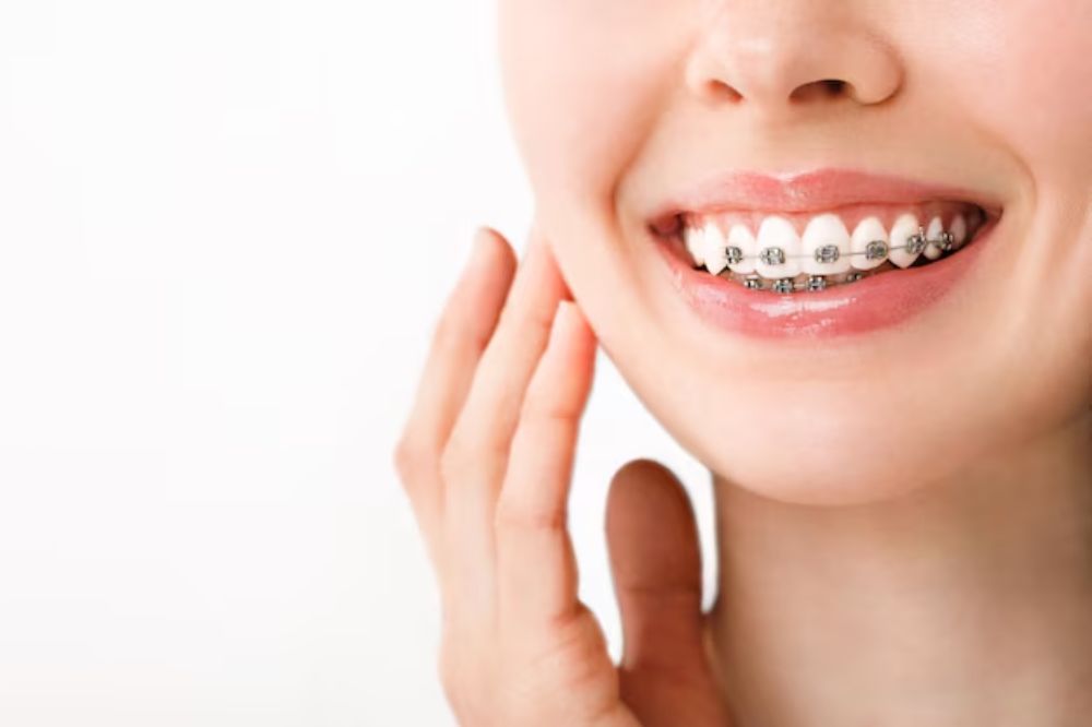 how to prevent cavities during orthodontic treatment