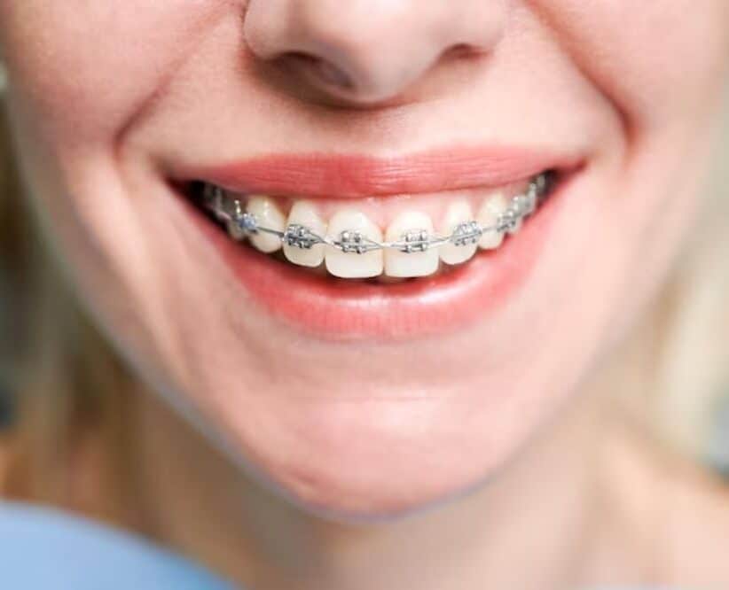 what is the average cost of braces and how can i afford them