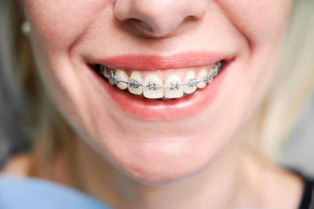 what is the average cost of braces and how can i afford them