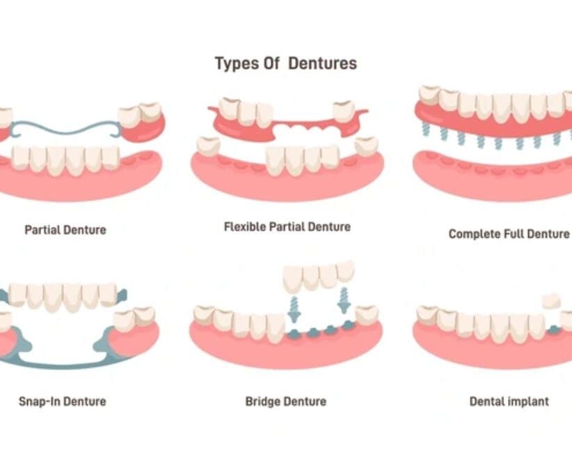 how to choose the right type of denture for your needs