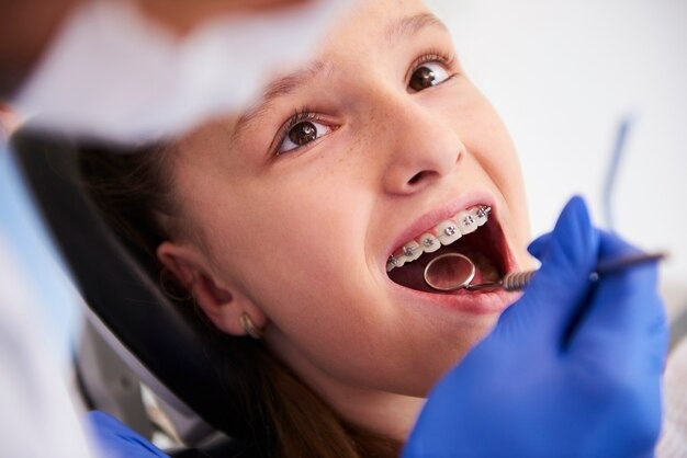 How to maintain results after orthodontic treatment